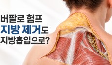 버팔로 험프 지방 제거도 지방흡입으로 할 수 있나요?