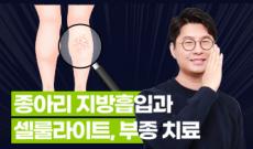 종아리 지방흡입과 셀룰라이트, 부종 치료 방법
