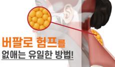 버팔로 험프 지방흡입으로 해결할 수 있나요?