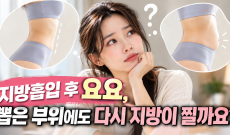 지방흡입 후 요요, 뽑은 부위에도 다시 지방이 찔까요?