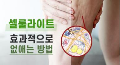 셀룰라이트 없애는 방법 (치료, 생기는 이유 등)