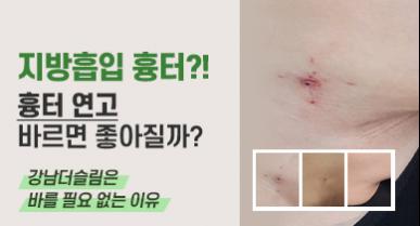 지방흡입 흉터?! 흉터 연고 바르면 좋아질까?