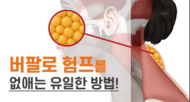 버팔로 험프 지방흡입으로 해결할 수 있나요?