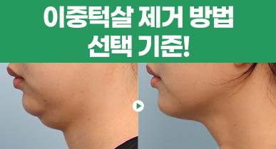 이중턱살제거 방법 선택 기준