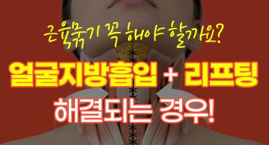 근육묶기 꼭 해야 할까요? 얼굴지방흡입과 리프팅으로 해결되는 경우