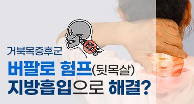 버팔로 험프 지방제거는 어떻게?