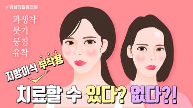 얼굴지방이식 부작용(과생착) 치료할 수 있다 없다