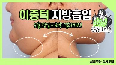 이중턱지방흡입 후 일상생활 언제부터?!