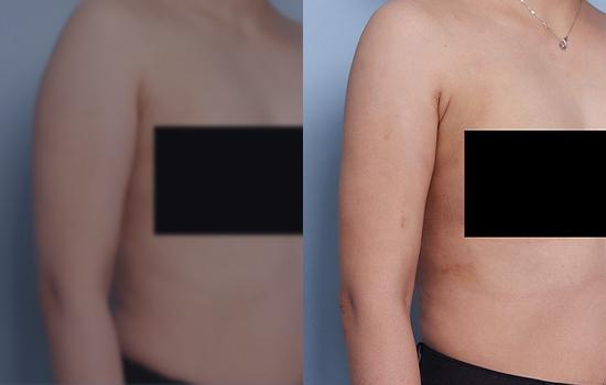 160cm/53.6kg/팔뚝/1200cc/1개월