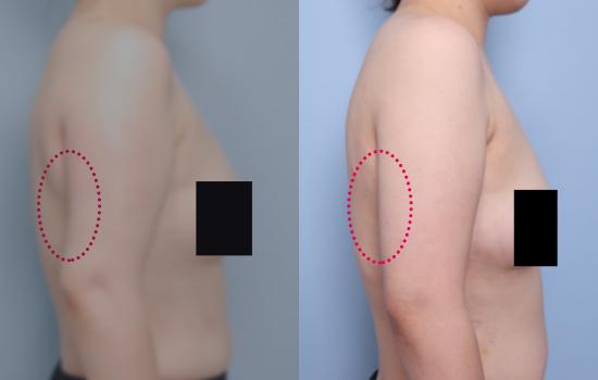 153cm/53kg/팔 재수술/850cc(이식 150cc)/15일