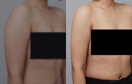 160cm/54.1kg/팔뚝지방흡입/3개월