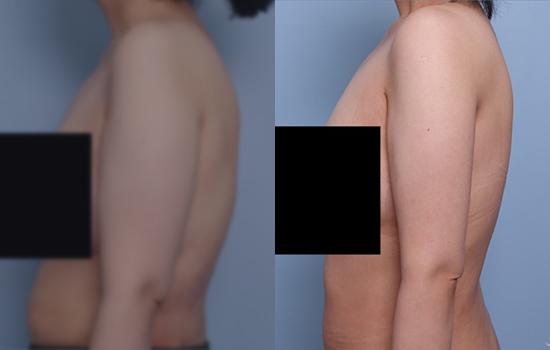 158cm/55.1kg/팔지흡+벨로디/500cc/2개월