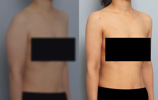 3개월 후/160cm/53kg/1300cc