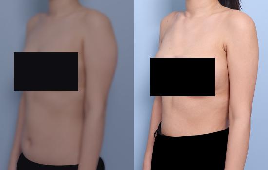 166cm/56kg/팔 지방흡입 /1200cc/1개월 