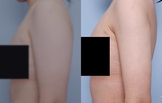 168cm/64.3kg/팔/1500cc/2개월