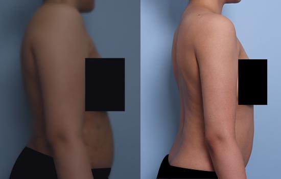170cm/75.7kg/팔 지방흡입/1600cc/3개월 