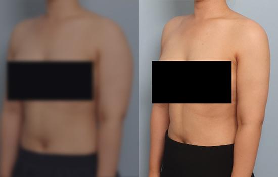 160cm/59.9kg/팔 지방흡입+저고릿살 벨로디/1600cc/2개월 후