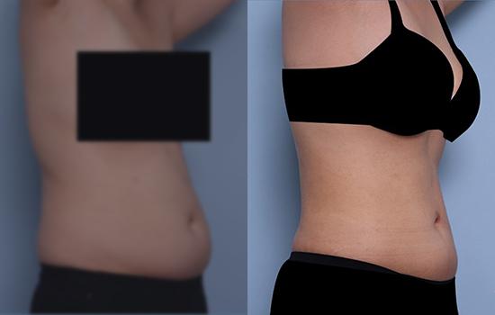 158cm/54.2kg/복부/2700cc/2개월