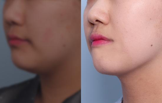 168cm/턱 지방흡입+벨로디2 /60cc/1년 5개월