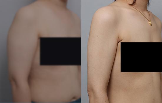 159cm/62.3kg/팔지흡/800cc/3개월