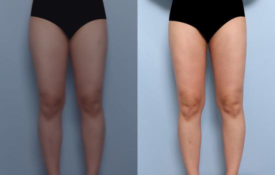 163cm/54.6kg/허벅지 지방흡입 /1800cc/2개월