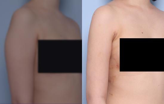 170cm/56.8kg/팔뚝/1200cc/15일후