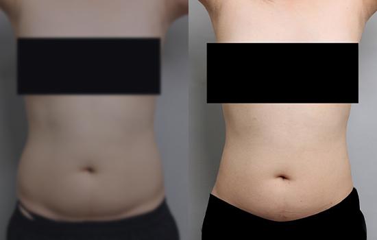 160cm/68.3kg/복부/2000cc/2개월