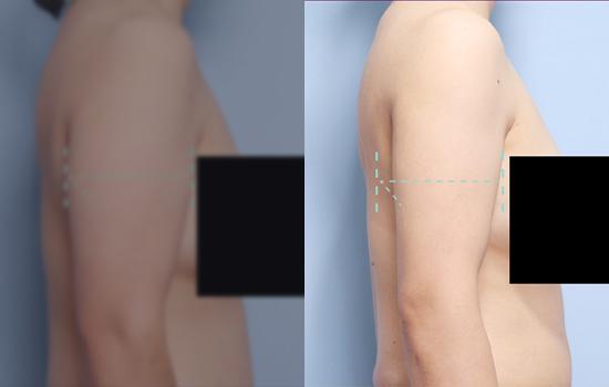 162cm/59.7kg/팔뚝지흡/1000cc/1개월