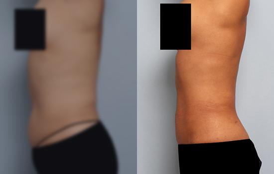 160cm/57kg/복부+앞배벨로디/1600cc/5개월