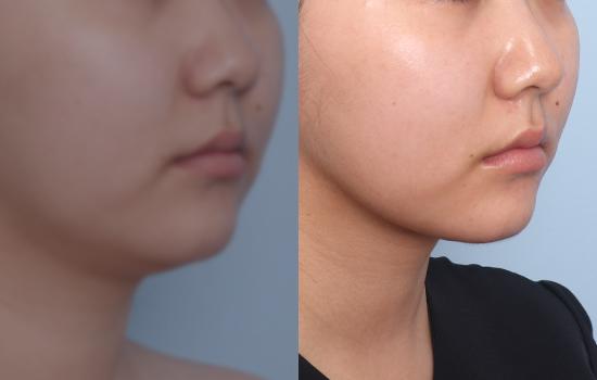 155cm/55kg/턱 지방흡입+벨로디2 /50cc/1개월