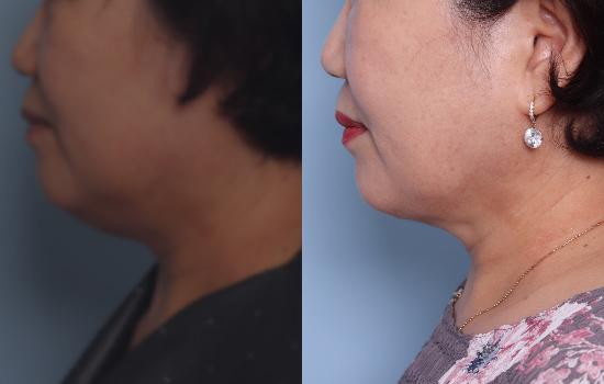 155cm/61.1kg/턱 지방흡입/55cc/3개월