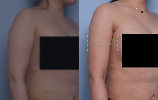 151cm/52.3kg/팔지흡/1400cc/1개월