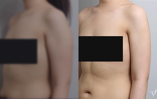 168cm/63.4kg/팔/1200cc/4개월