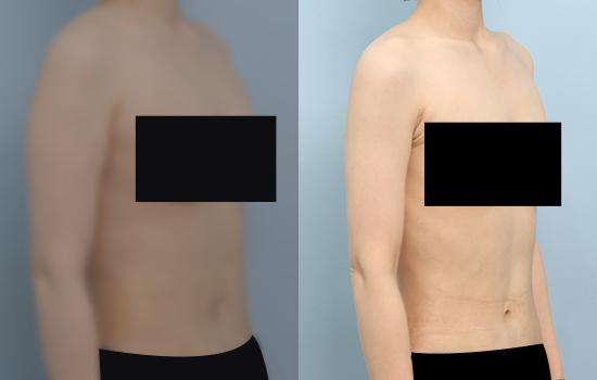162cm/58kg/팔 지방흡입/600cc/2개월
