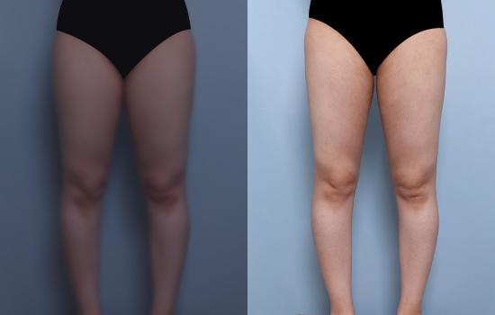 162cm/56.2kg/허벅지 지방흡입/2500cc/48일 