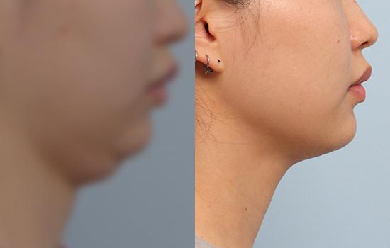 5개월 후/157cm/52kg/40cc