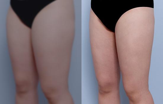 160cm/63kg/허벅지/3700cc/2개월