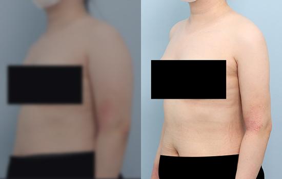 150cm/58kg/팔+등/3200cc/1개월