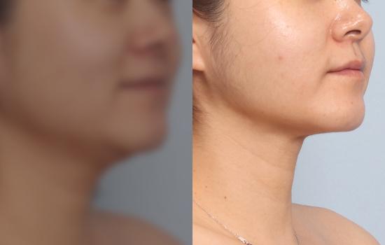 3개월 후/169cm/58kg/70cc