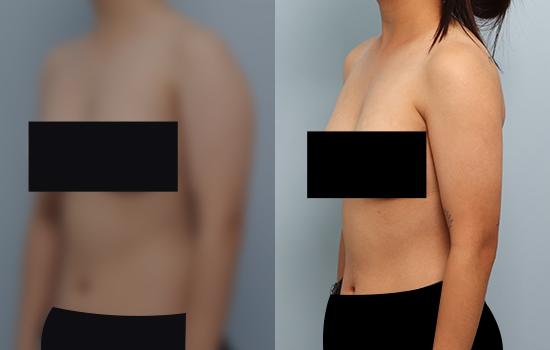 1개월 후/157cm/51kg/900cc