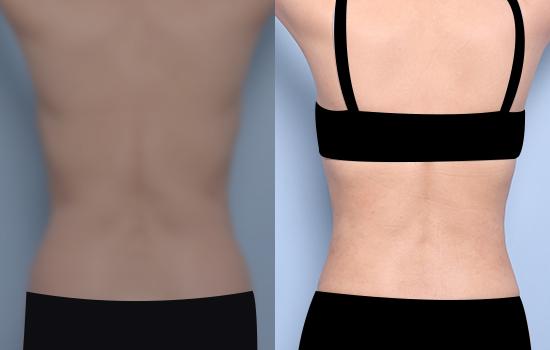 157cm/58.8kg/복부 지방흡입 /3000cc/1개월
