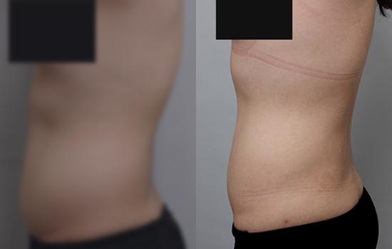 158cm/60.4kg/복부미니옆구리/1900cc/11개월