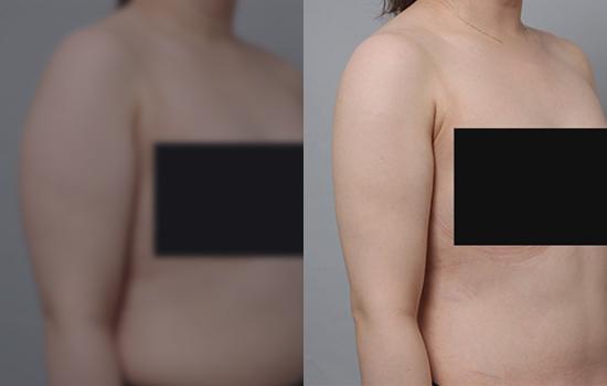 158cm/51.5kg/팔/900cc/1개월