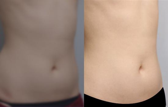 168cm/57.5kg/복부미니옆구리/1000cc/5개월 