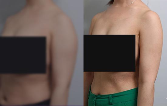 168cm/62.9kg/팔/1000cc/4개월