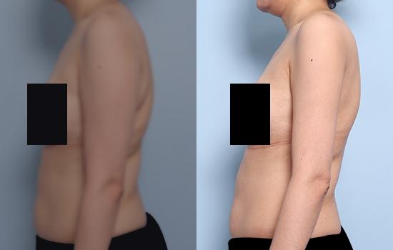 164cm/62kg/팔 지방흡입/1400cc/1개월