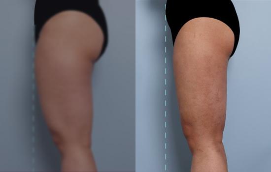 160cm/63.3kg/허벅지지흡/2700cc/1개월