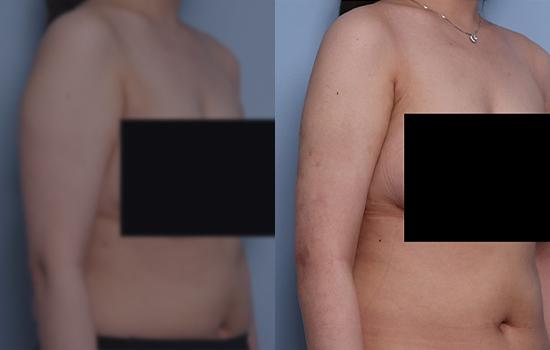 168cm/67.5kg/팔/2500cc/1개월