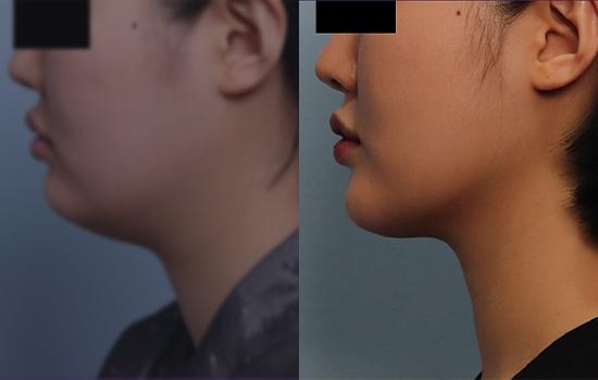 170cm/56.8kg/턱지흡+벨로디2/55cc/1개월