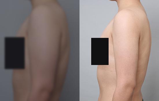 175cm/69.9kg/팔/1500cc/1개월